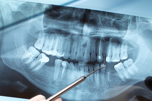 Exam, X-Ray, and Cleaning
