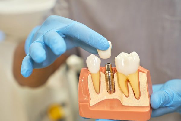dental implants in Avondale