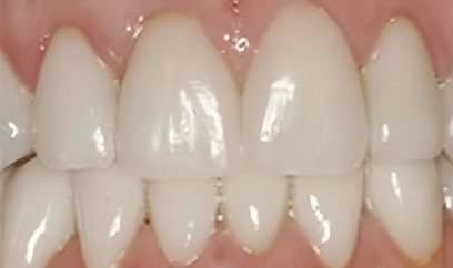 Smile Transformation After 1