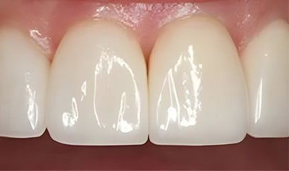 Smile Transformation After 2