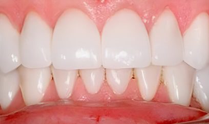 Smile Transformation After 3