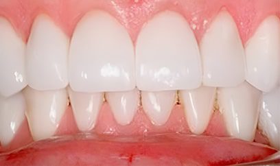 Smile Transformation After 4