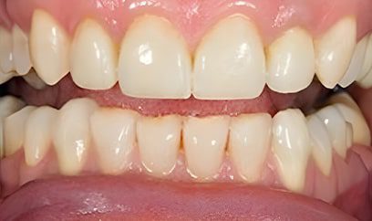 Smile Transformation After 5