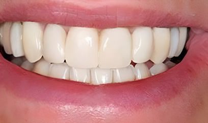 Smile Transformation After 6