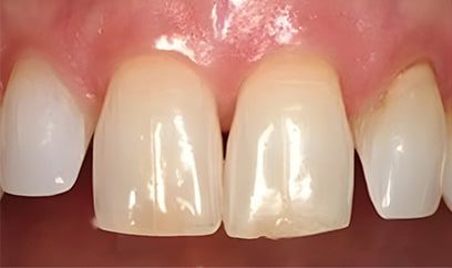 Smile Transformation Before 2