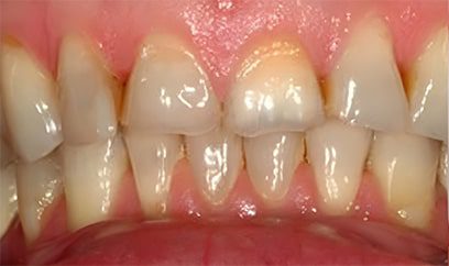 Smile Transformation Before 3