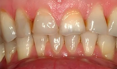 Smile Transformation Before 4
