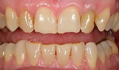 Smile Transformation Before 5