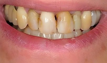 Smile Transformation Before 6