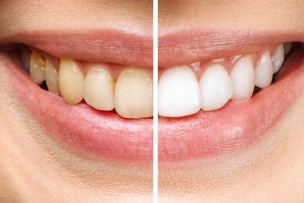 Teeth Whitening