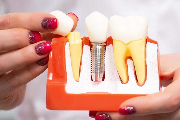 Single Tooth Implant Avondale