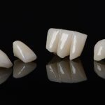 Temporary vs. Permanent Crown What is the Difference