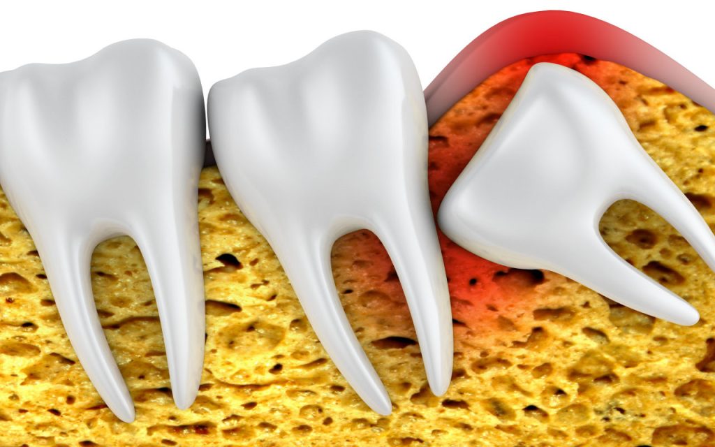 Wisdom Teeth Removal Avondale