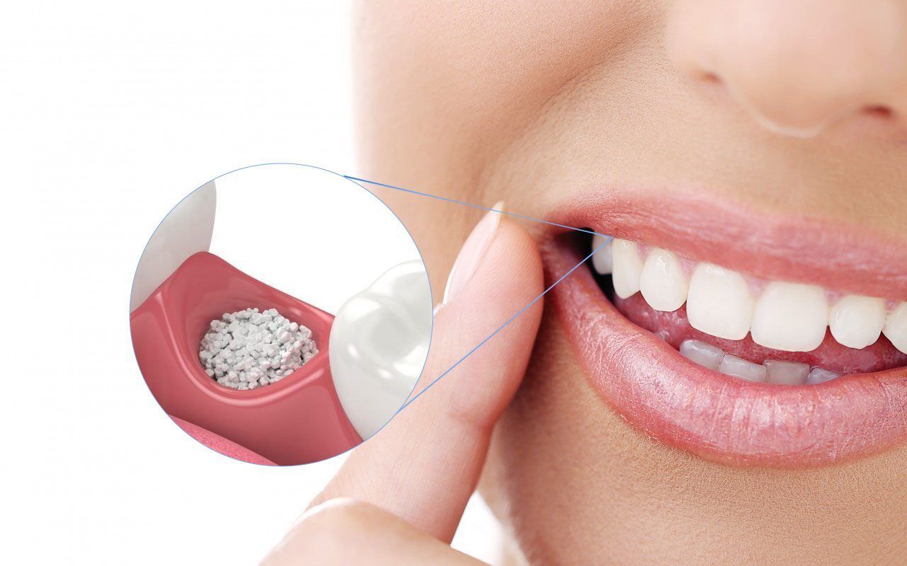 Dental Bone Graft in Avondale, Arizona