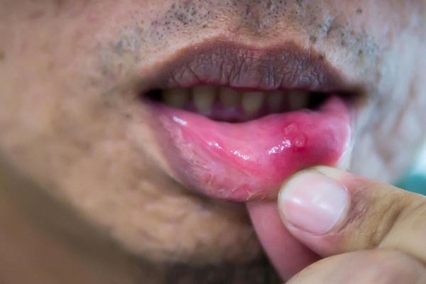Oral Cancer Screening