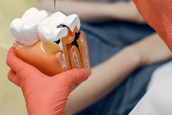 Root Canal