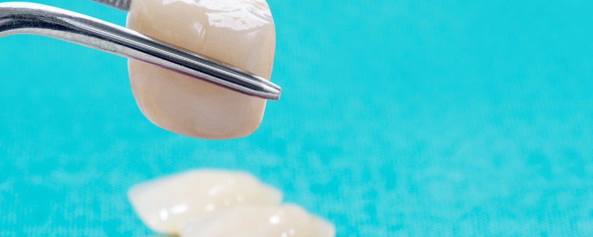 Steps to Dental Crown Preparation