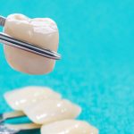 Steps to Dental Crown Preparation