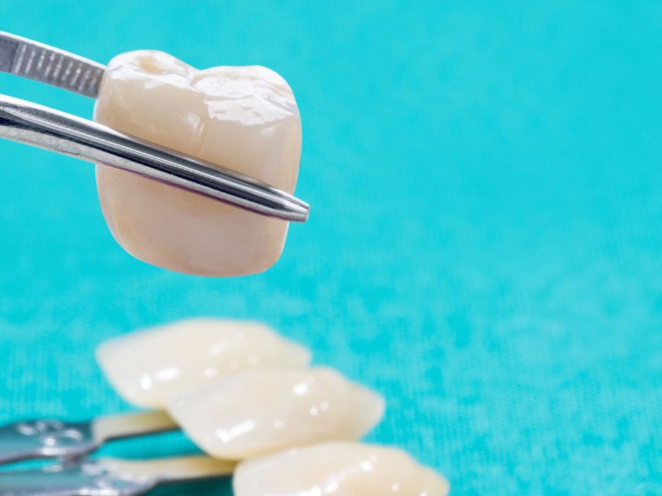 Steps to Dental Crown Preparation