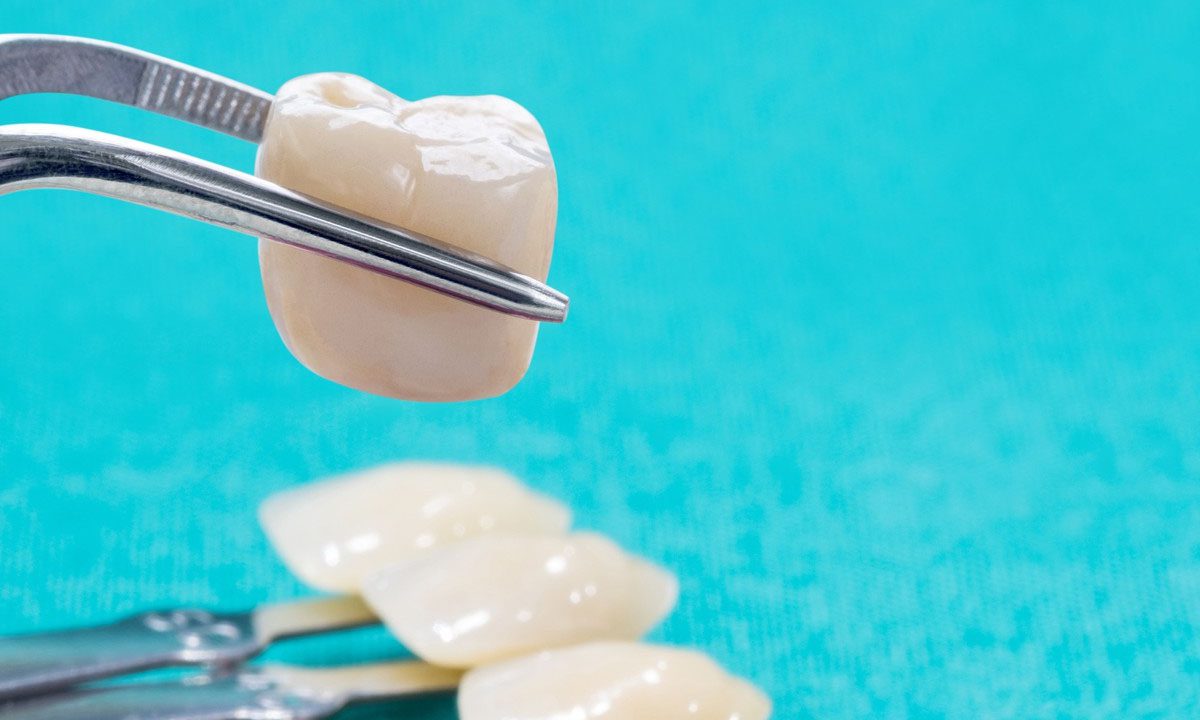 Steps to Dental Crown Preparation