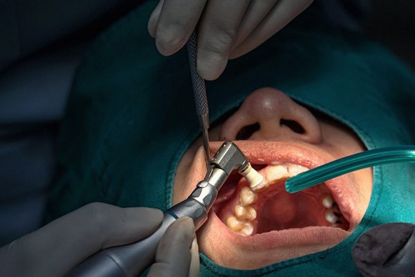Tooth Extraction Surgery in Avondale, Arizona(Service)