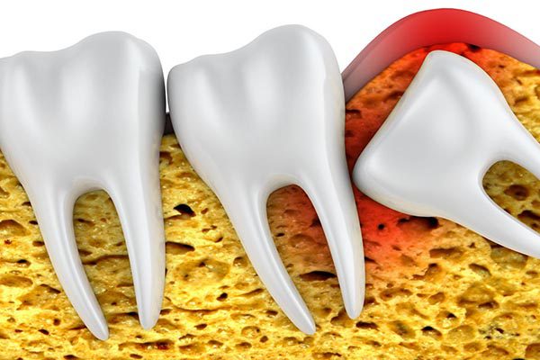 Wisdom Teeth Removal