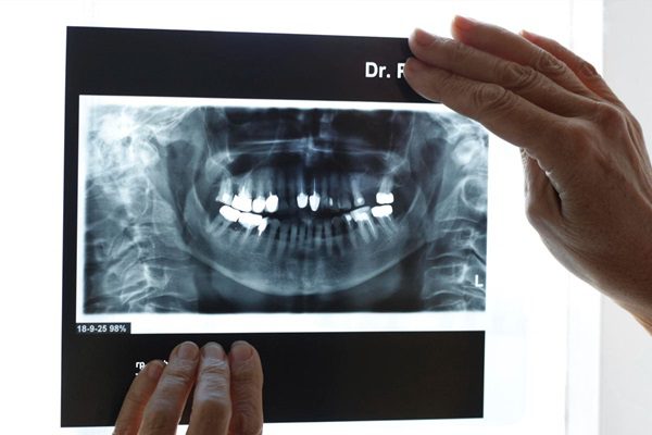 Dental X-ray