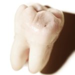 Do Wisdom Teeth Cause Tooth Decay?
