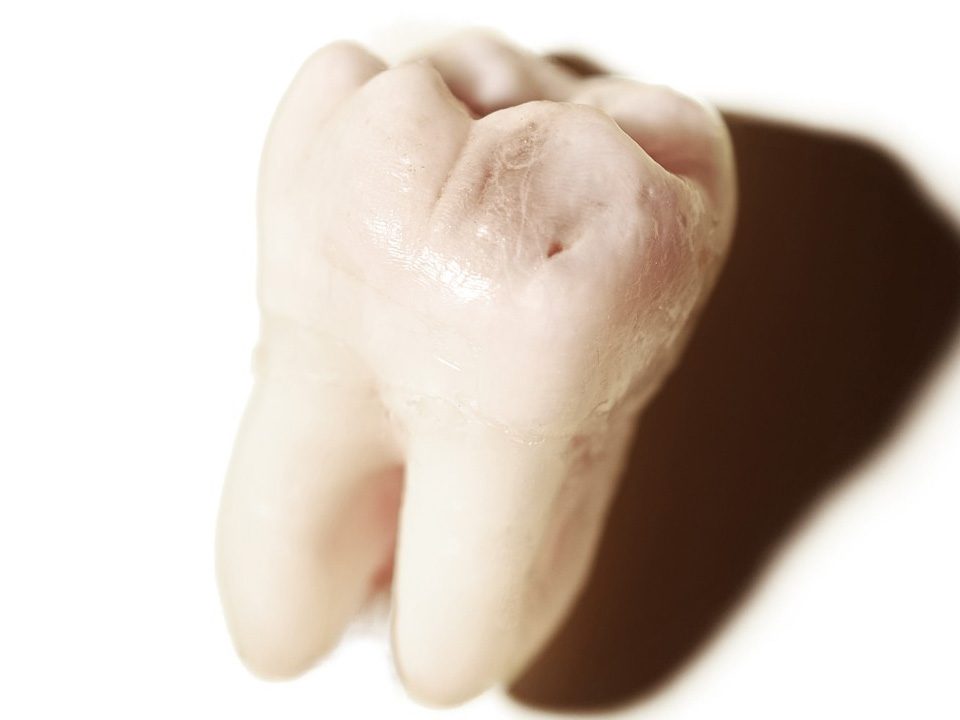 Do Wisdom Teeth Cause Tooth Decay?