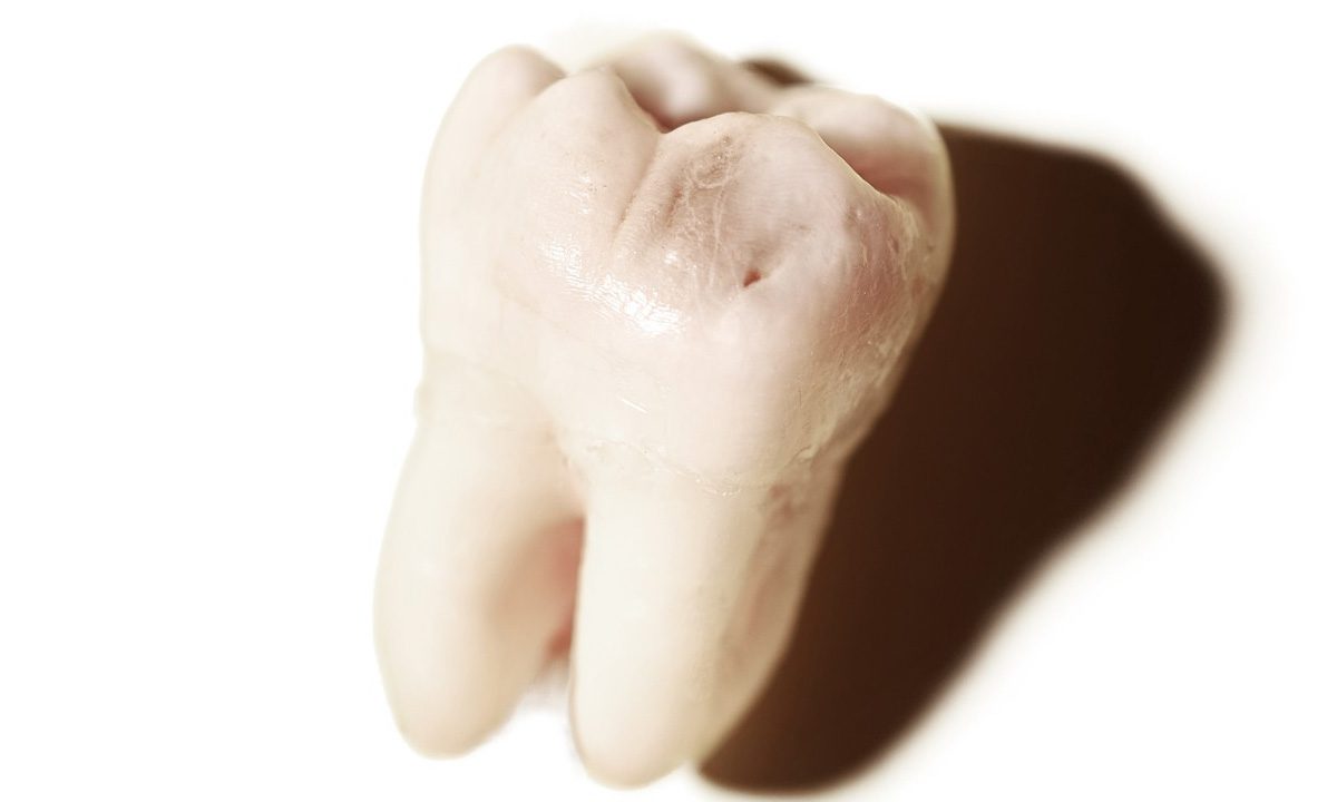Do Wisdom Teeth Cause Tooth Decay?