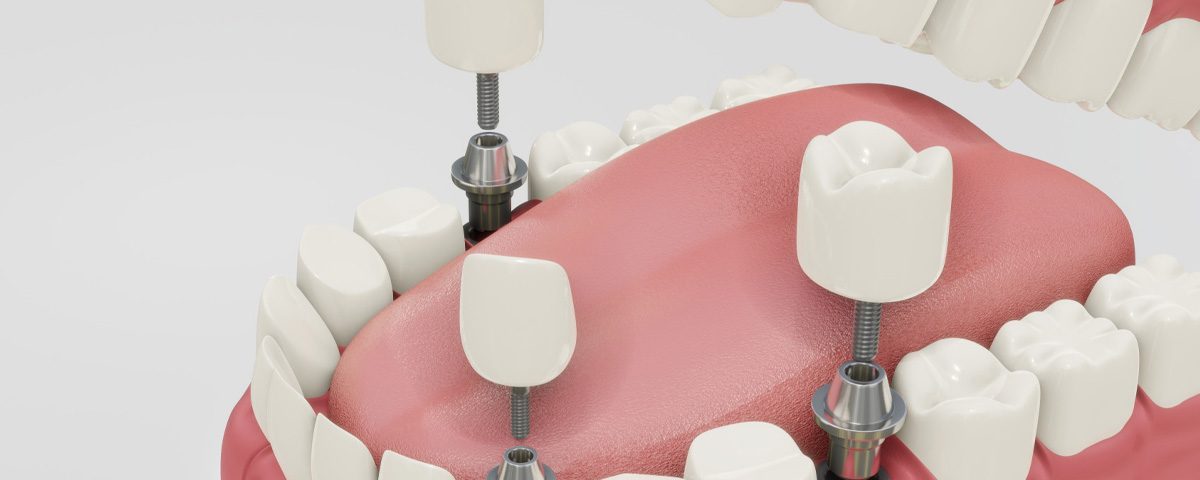 How Long Do Dental Implants Last