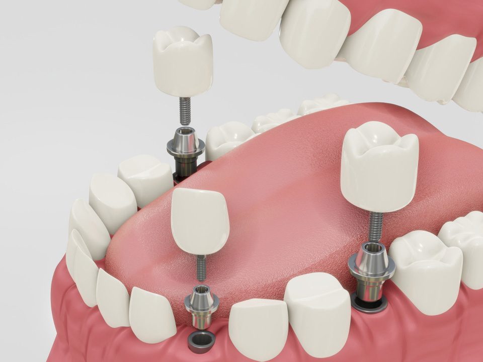 How Long Do Dental Implants Last