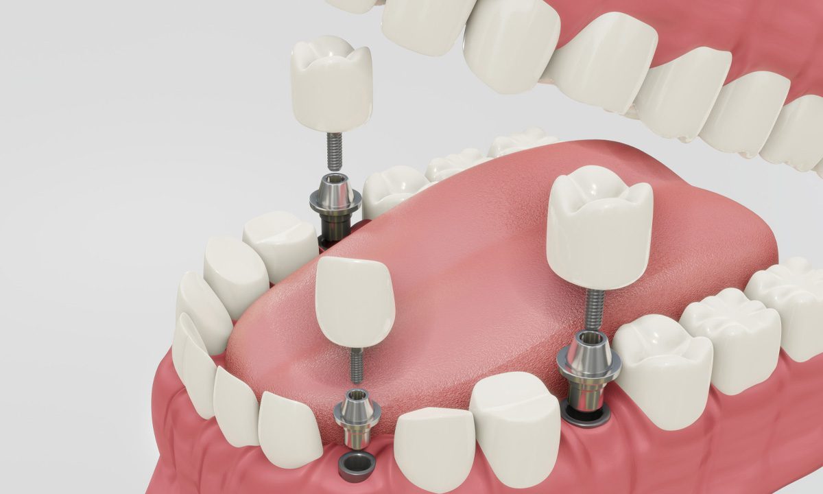 How Long Do Dental Implants Last
