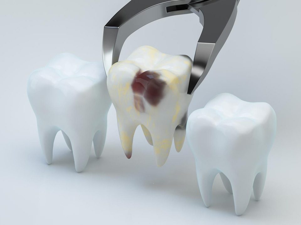 How Long to Keep Gauze in after Tooth Extraction