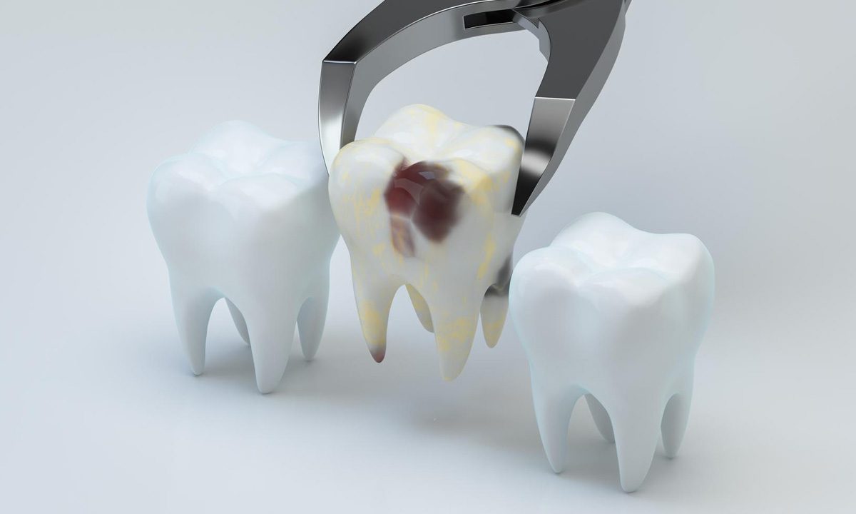 How Long to Keep Gauze in after Tooth Extraction