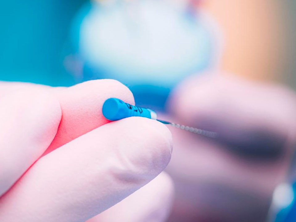 Root Canal and Crown Costs and Differences