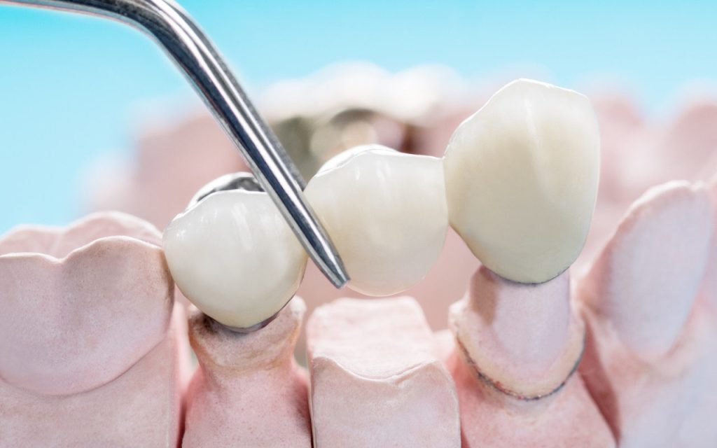 Fixed Implant Bridges Avondale