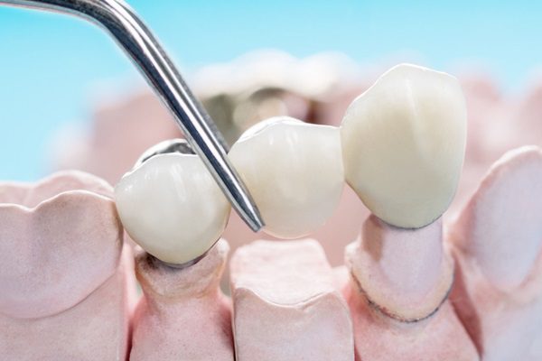 Fixed Implant Bridges in Avondale, Arizona - Service