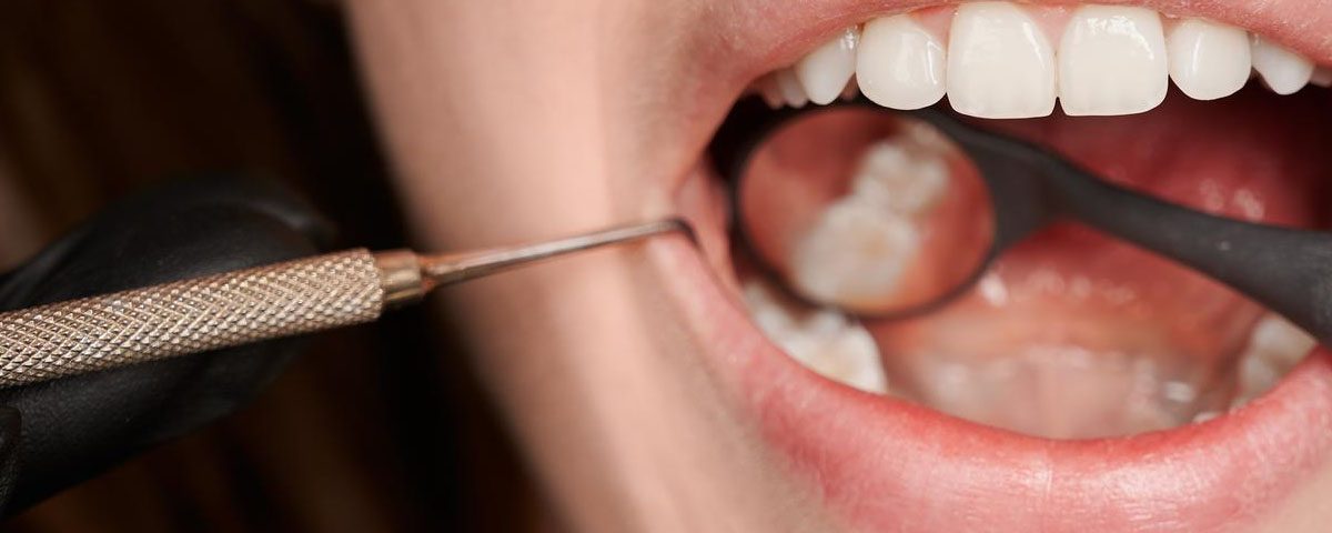 What are the Stages of Tooth Decay