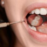 What are the Stages of Tooth Decay