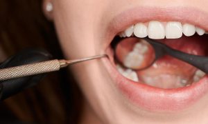 What are the Stages of Tooth Decay