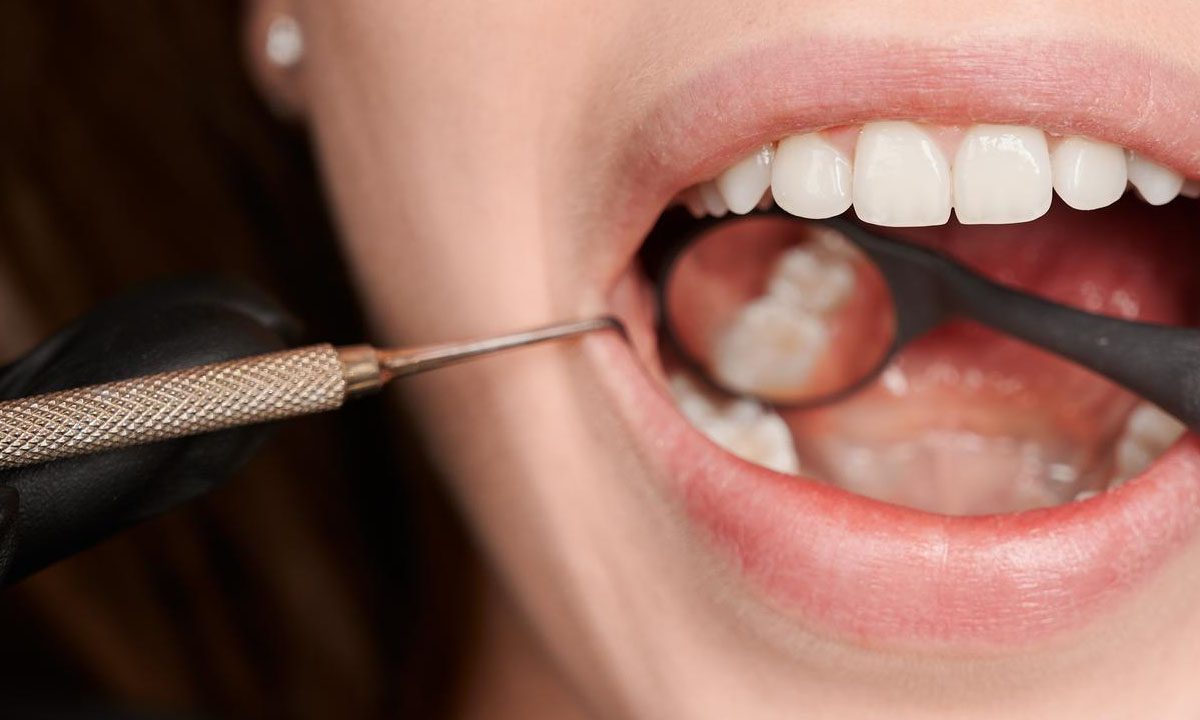 What are the Stages of Tooth Decay