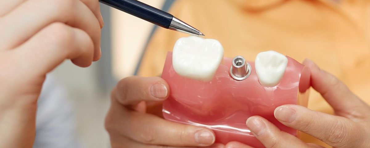 Pros and Cons of Same-Day Dental Implants