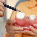 Pros and Cons of Same-Day Dental Implants