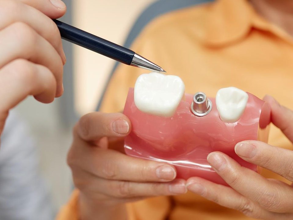Pros and Cons of Same-Day Dental Implants