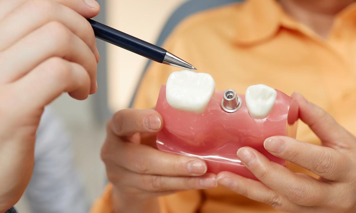 Pros and Cons of Same-Day Dental Implants