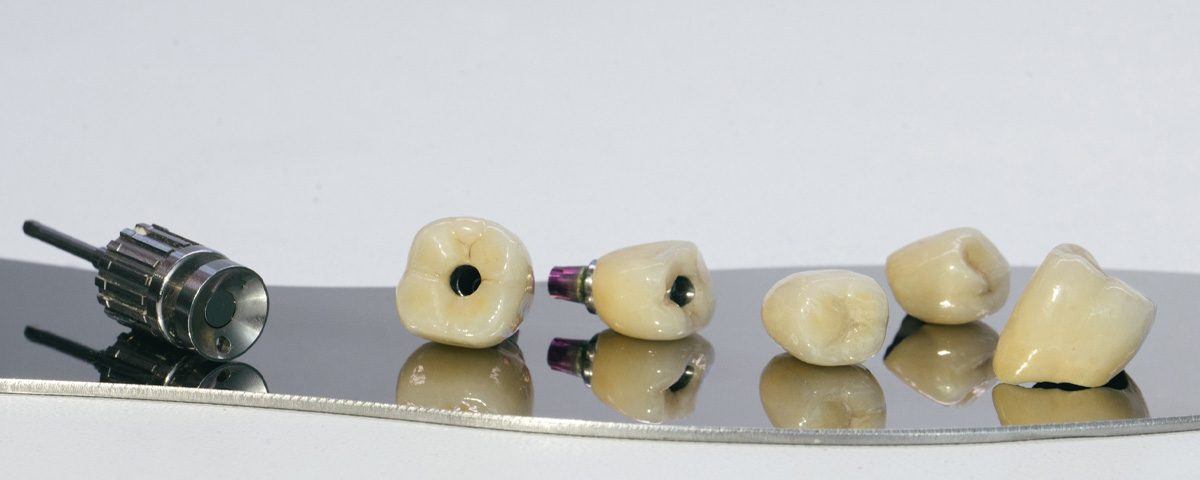 Single Tooth Replacement Bridge vs. Implant-Supported Restoration