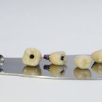 Single Tooth Replacement Bridge vs. Implant-Supported Restoration