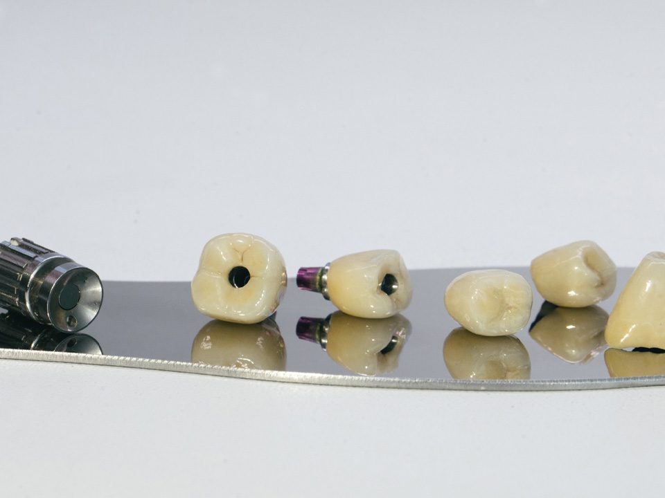 Single Tooth Replacement Bridge vs. Implant-Supported Restoration