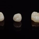 How Long do Porcelain Dental Crowns Last?